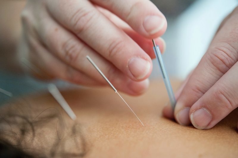 5 Little Known Facts About Acupuncture