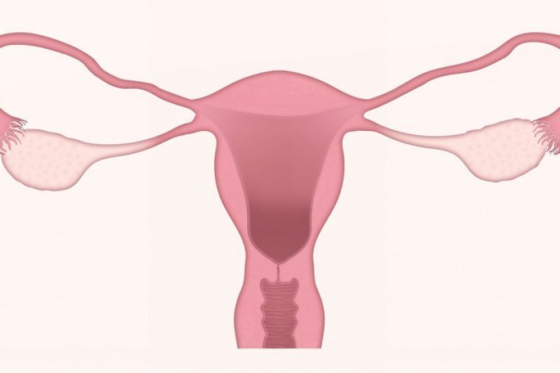 Pcos and Homeopathy