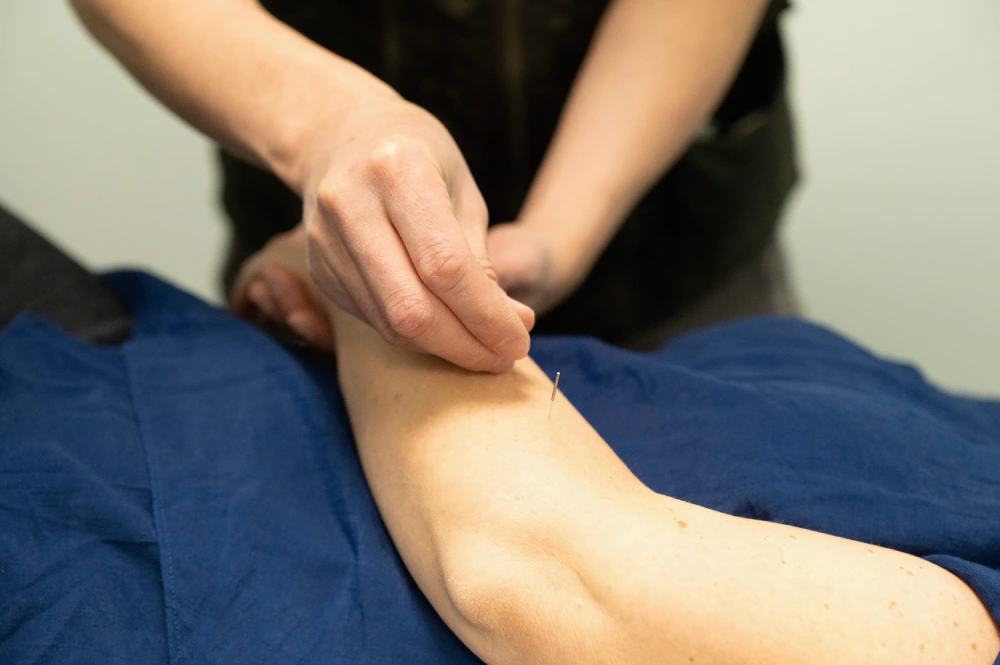 acupuncture-toronto